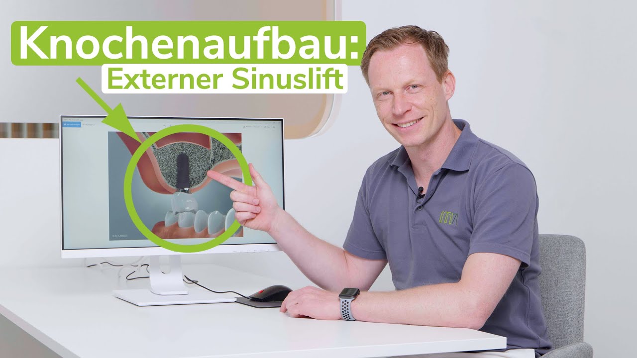 Knochenaufbau für Zahnimplantate: Externer Sinuslift - Was ist das? | m71 - Zahnärzte