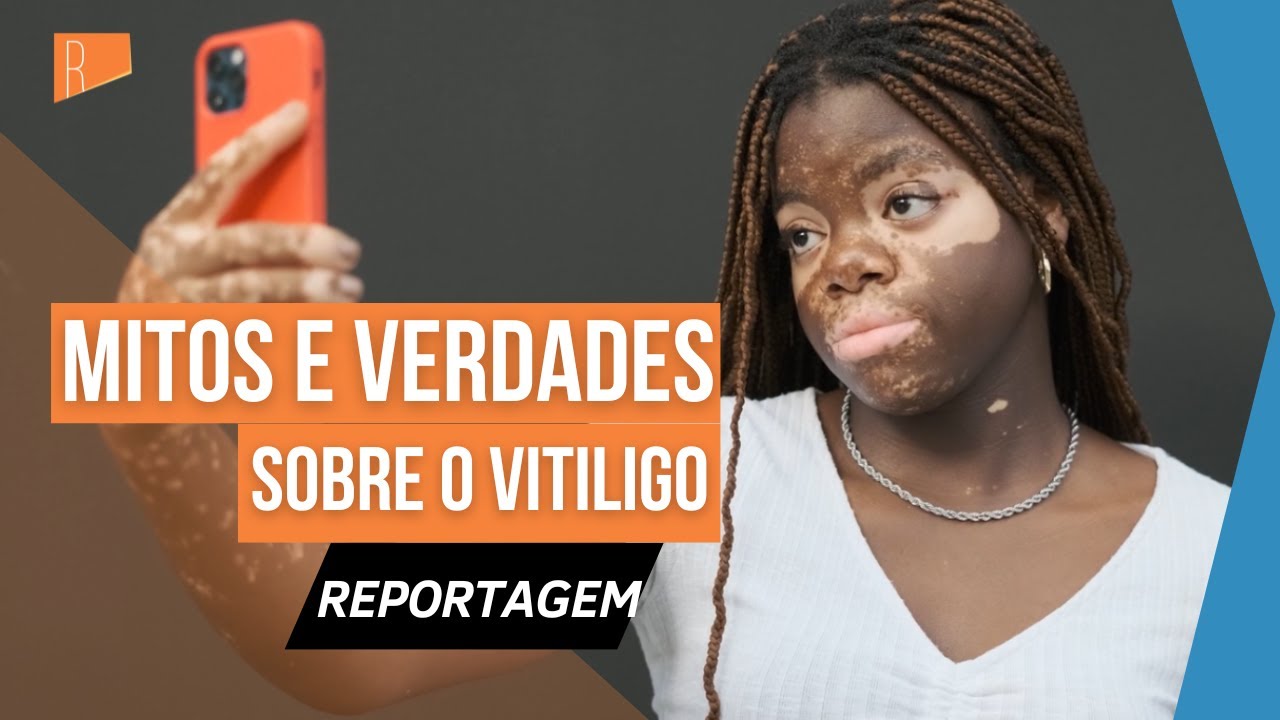 Descubra os mitos e verdades sobre o vitiligo‌