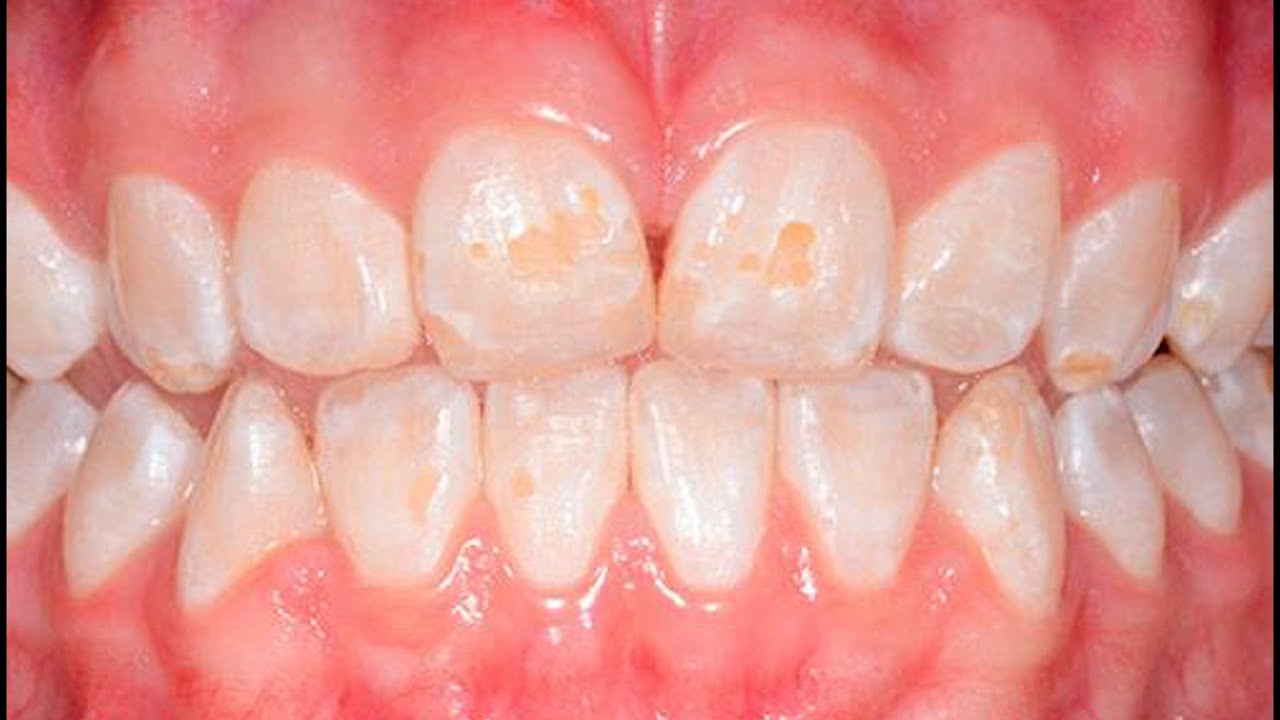 ¿Qué es la hipoplasia del esmalte y cómo tratarla?