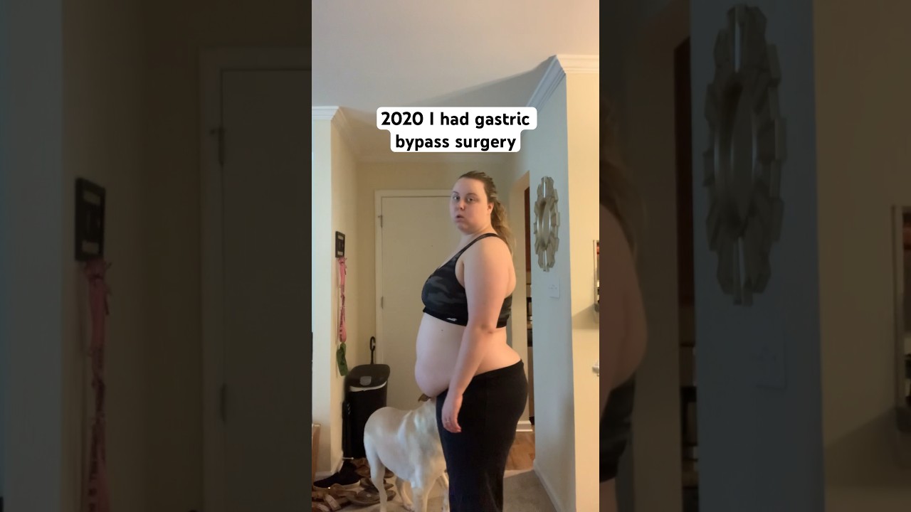 My gastric bypass results  #gastricbypasssurgery