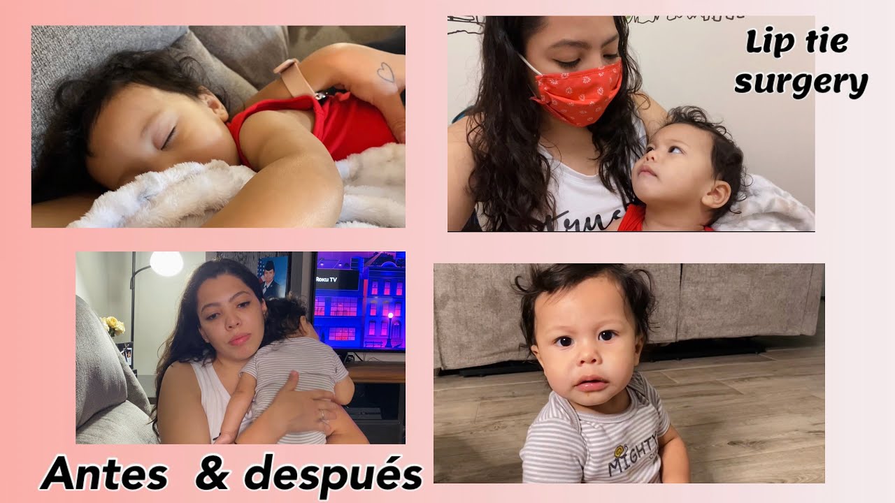 Lip tie surgery Vlog | #cirug&iacute;a antes & despu&eacute;s | como le fue a mi beb&eacute; 👶🏻