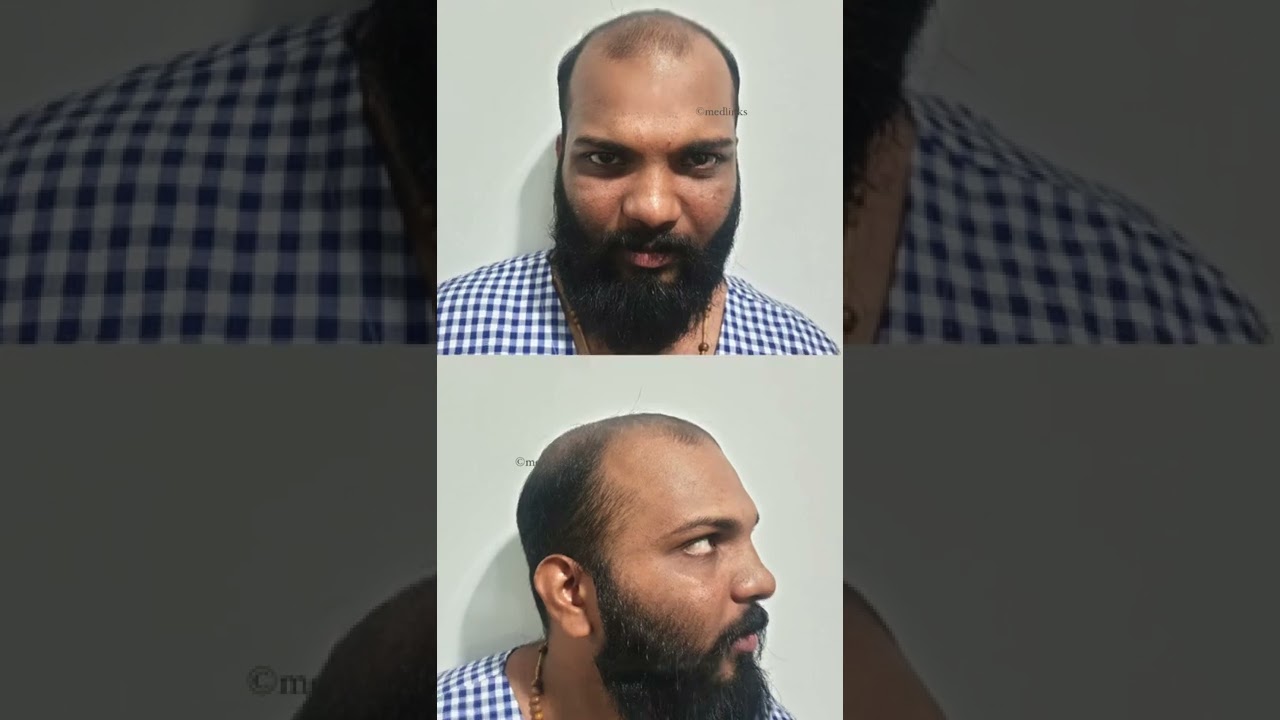 {2024 } {Grade 6 }🔥Hair Transplant Results #shorts #medlinks