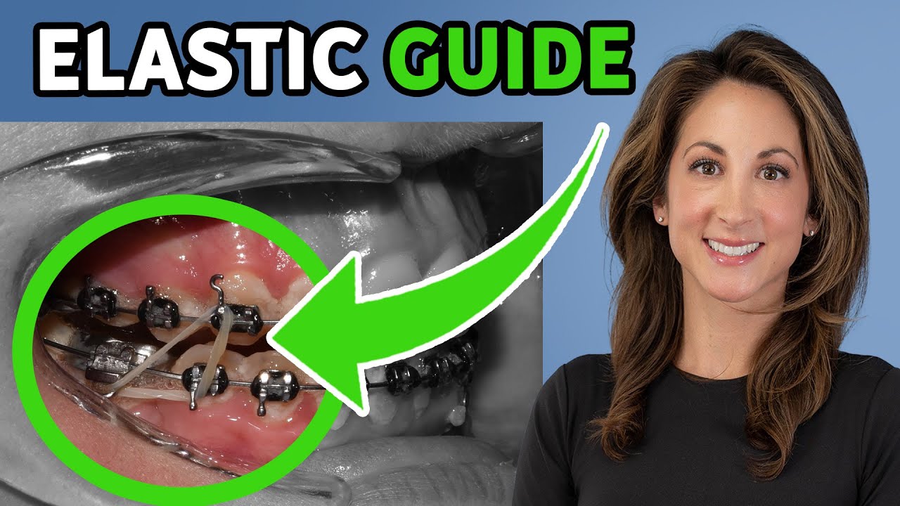 How to Use Orthodontic Elastics After Jaw Surgery
