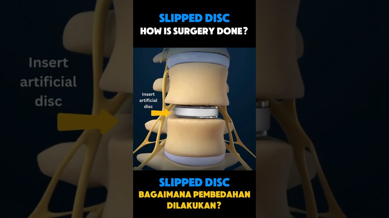 How Slipped Disc Surgery Performed? Endoscopic & Artificial Disc Replacement #slipdiscsurgery