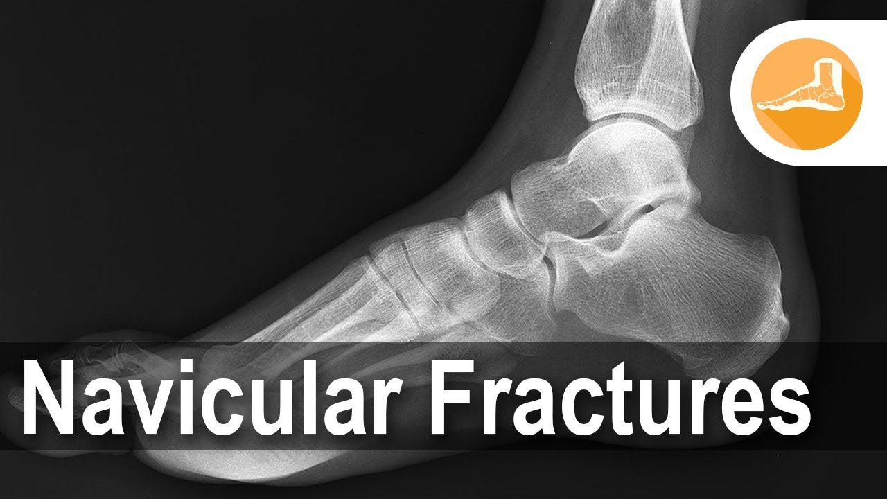 Navicular Fractures with Dr. Erik Nilssen