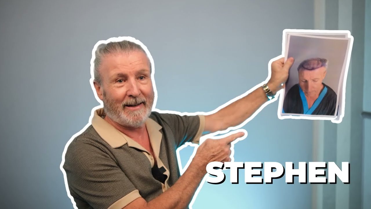 "WELCOME TO NEW ME GUYS!" - Amazing Hair Transplant Result in just ONE SESSION!