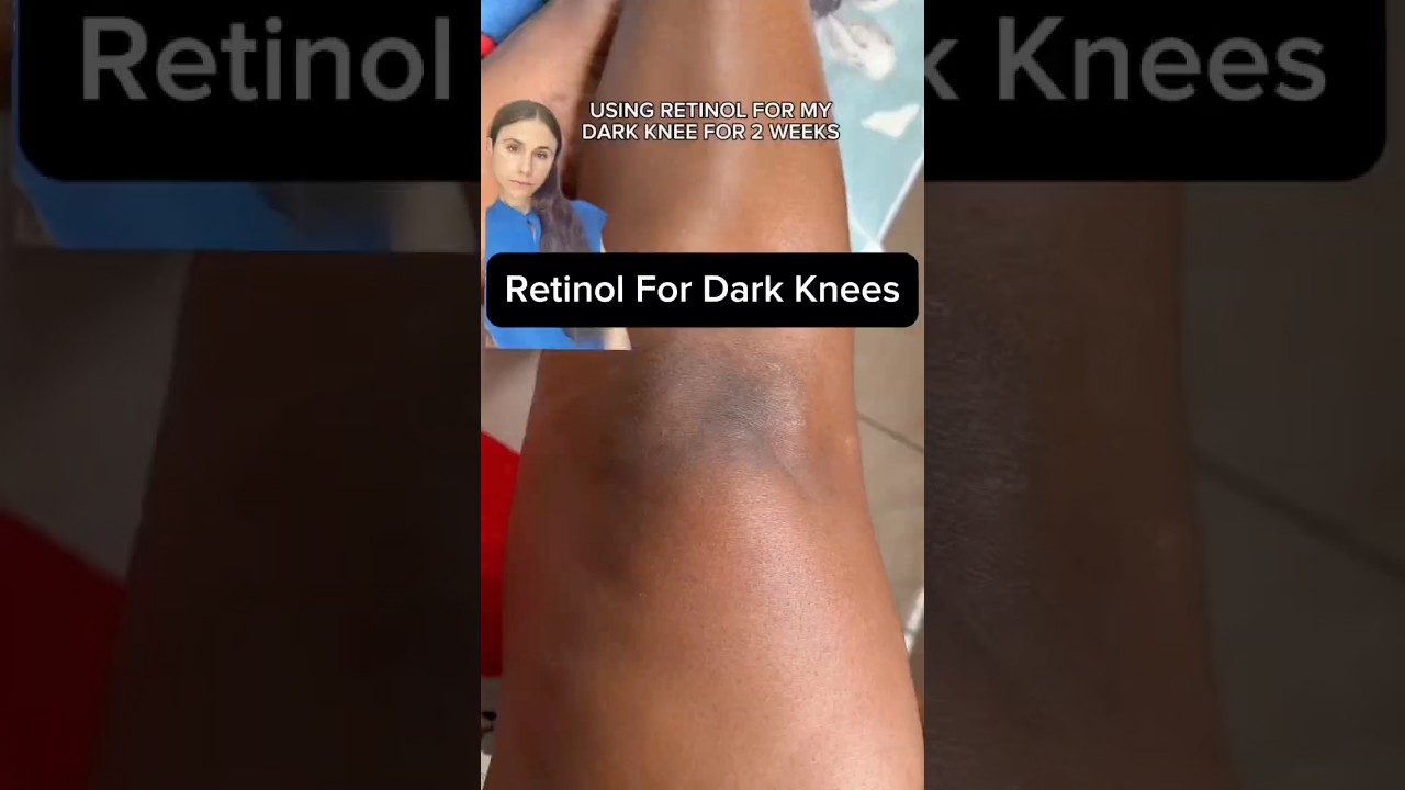 Dark Knees Vanish With This Retinol Secret #dermatologist