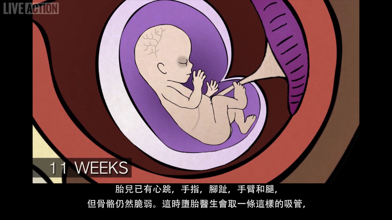 懷孕12週前的手術墮胎法：抽吸刮宮術（繁體字幕）