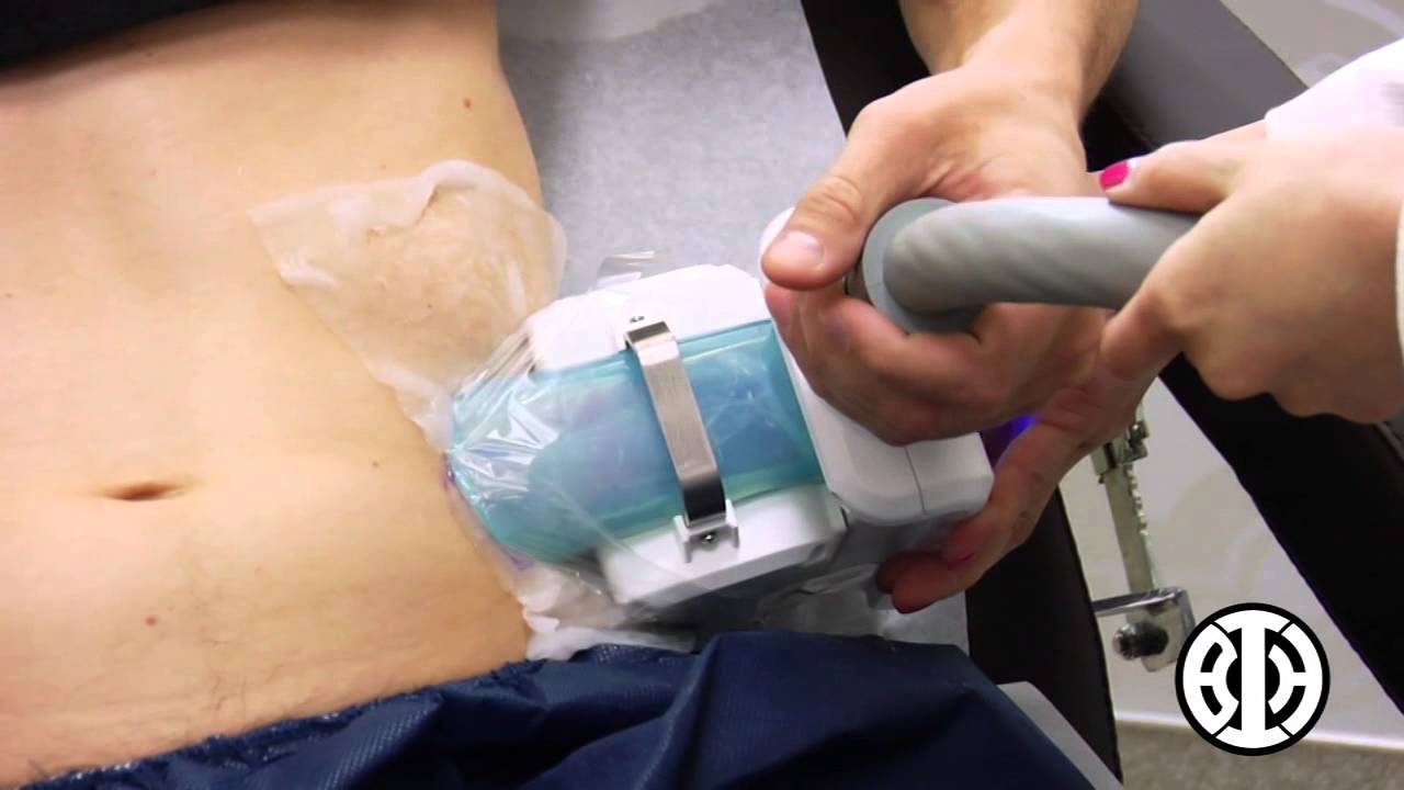 CoolSculpting to treat men's love handles