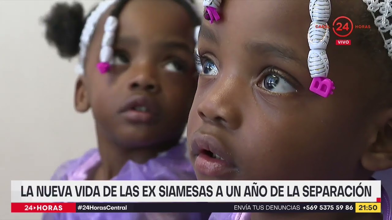La nueva vida de las ex siamesas a un año de la separación