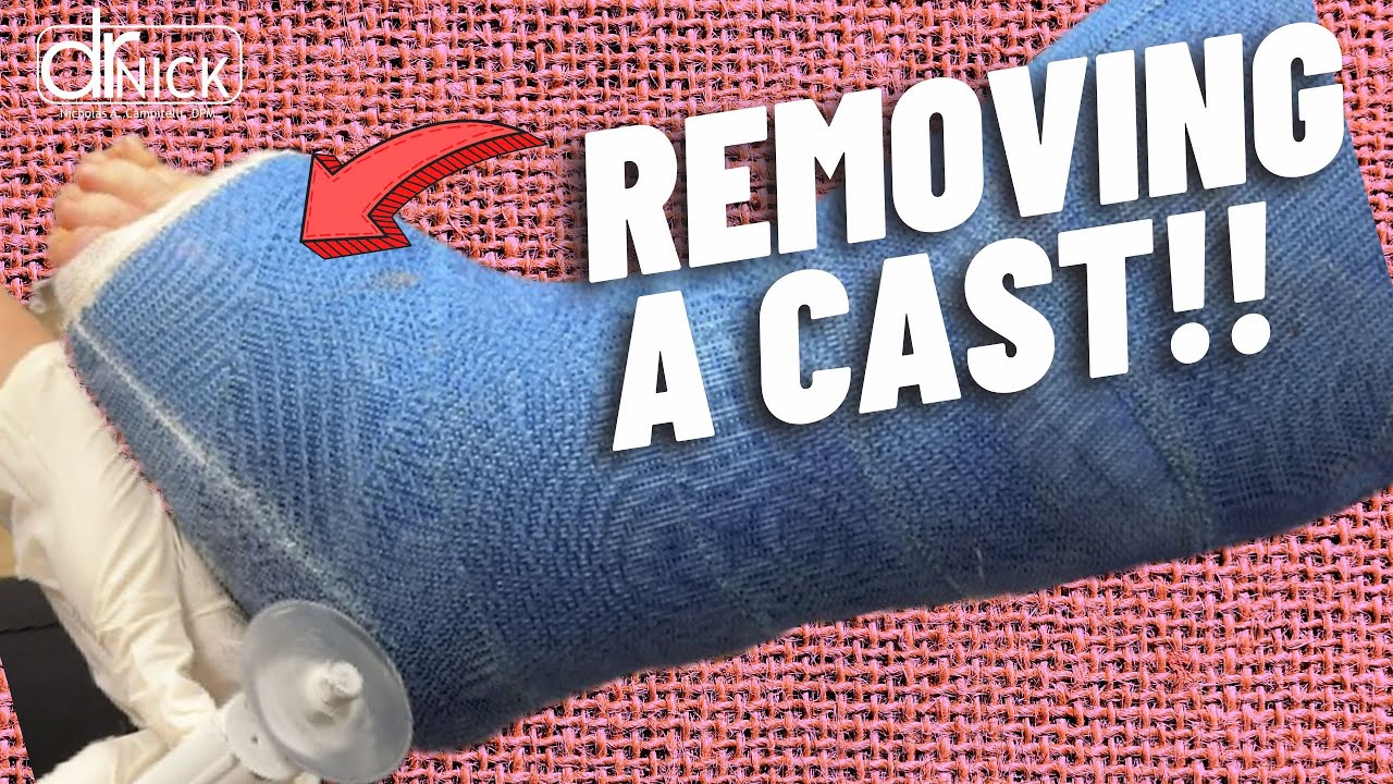 How To Remove a Cast! Dr Nick Campitelli