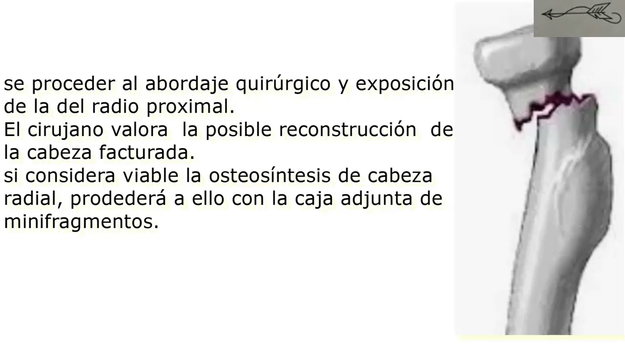 Prótesis de cúpula radial  preparar la instrumentación con pocos datos