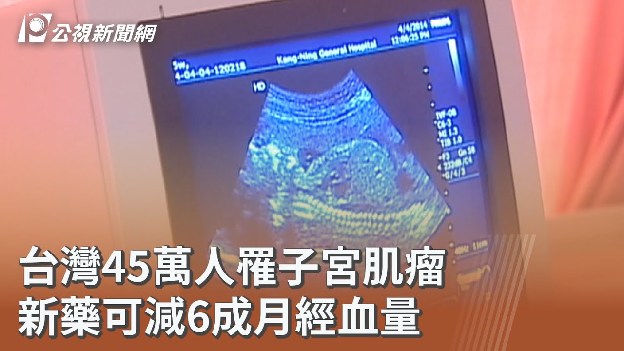 台灣45萬人罹子宮肌瘤 新藥可減6成月經血量｜20260305 公視午間新聞