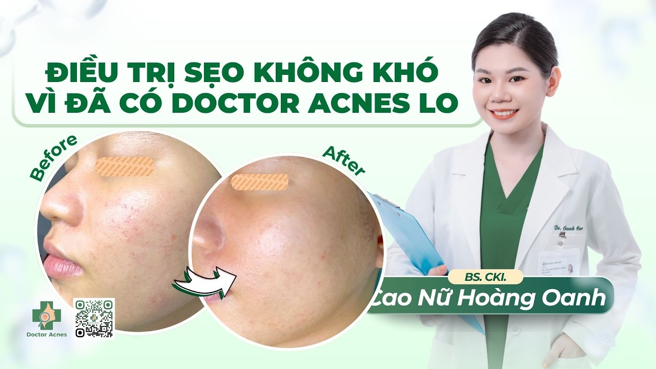 DOCTOR ACNES - ĐIỀU TRỊ SẸO KHÔNG KHÓ VÌ ĐÃ CÓ DOCTOR ACNES LO