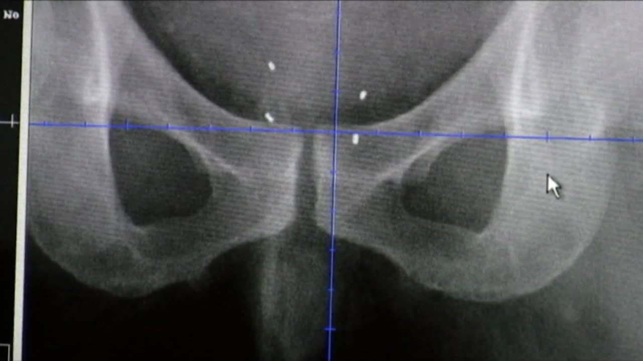 Linear accelerator and software upgrades benefit patients