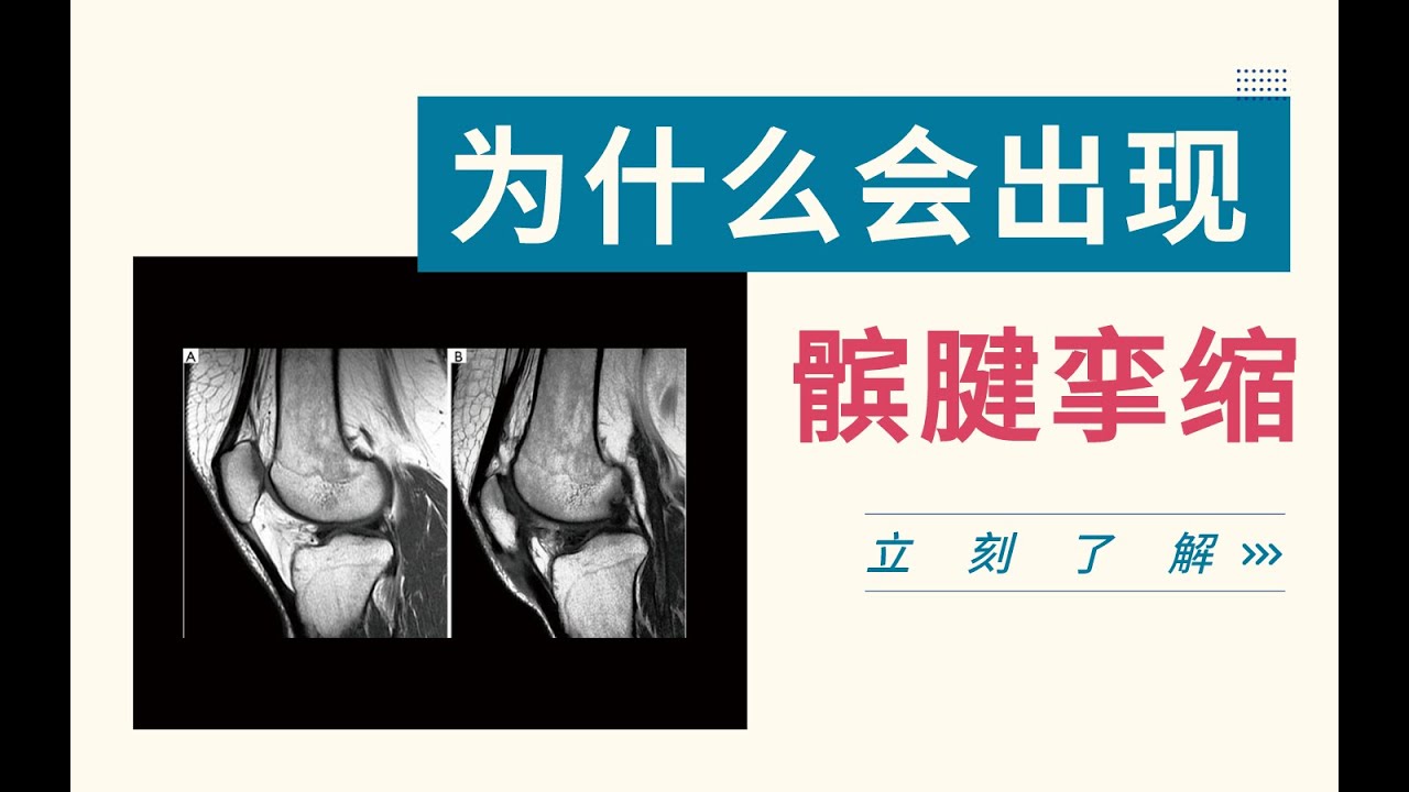 为什么会出现髌腱挛缩？