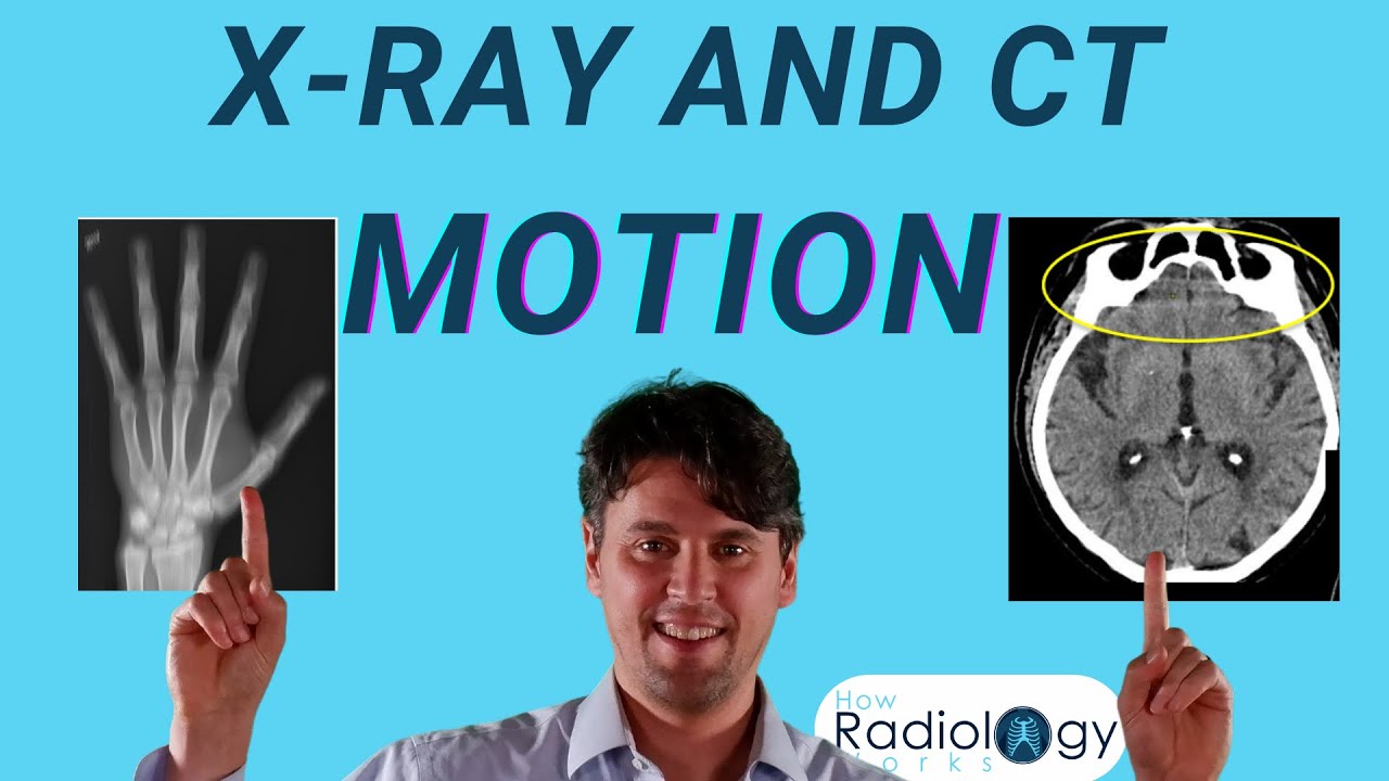 CT motion artifacts (Motion Blur in X-ray)