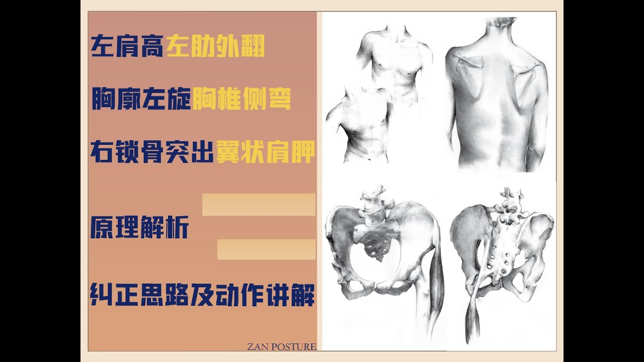 左肩高左肋外翻，胸廓左旋，右侧翼状肩胛的纠正思路