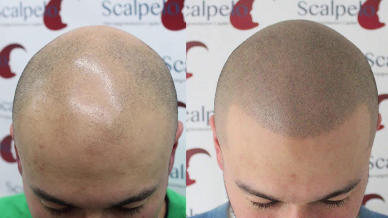 Micropigmentacion Capilar antes y después  de Antony