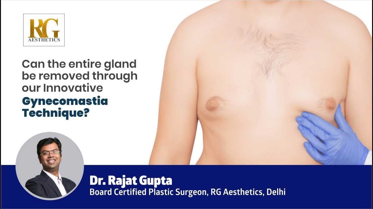 Can the entire gland be removed through our Innovative Gynecomastia Technique? Dr. Rajat Gupta
