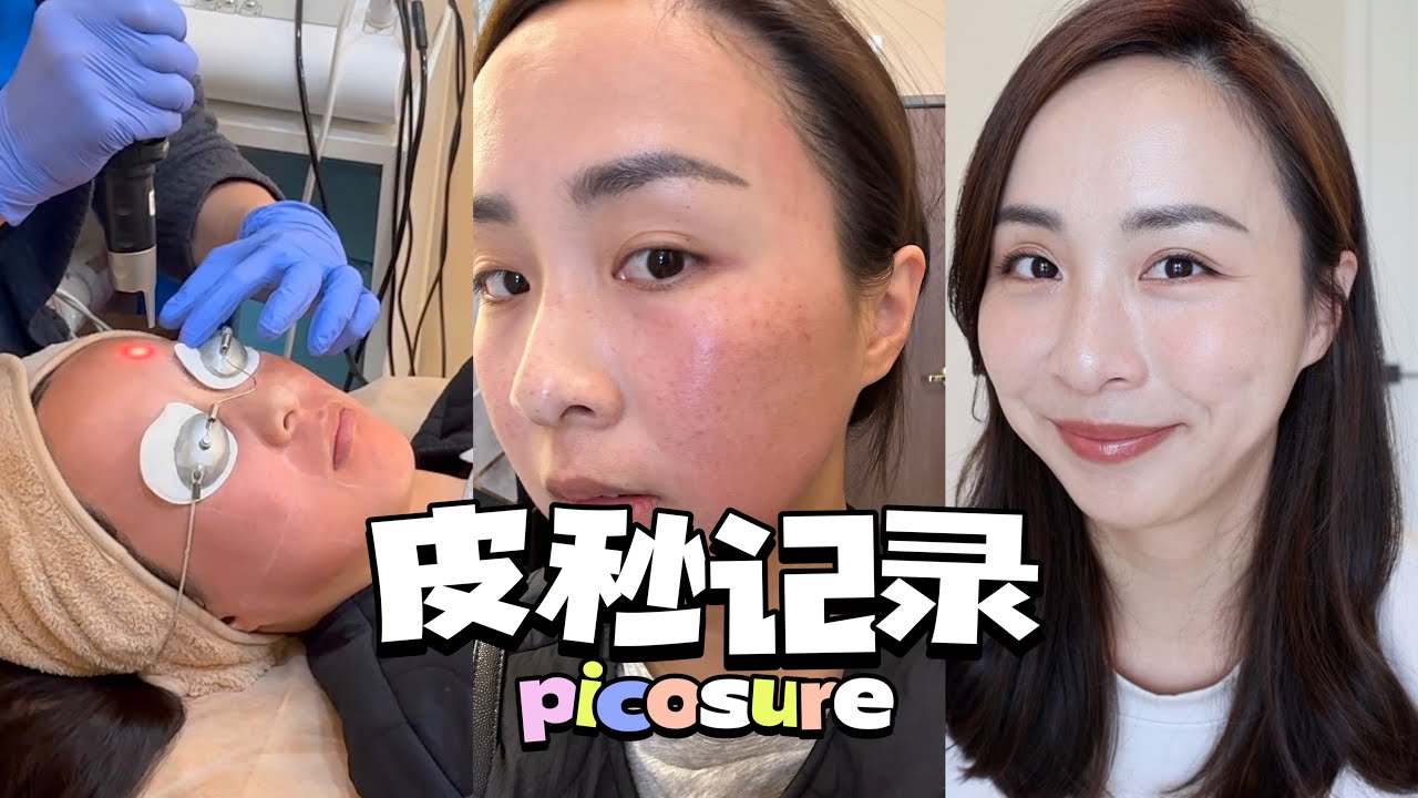 🩸蜂巢皮秒记录｜过程+修复｜祛斑效果｜如何防止反黑｜医美｜PICOSURE
