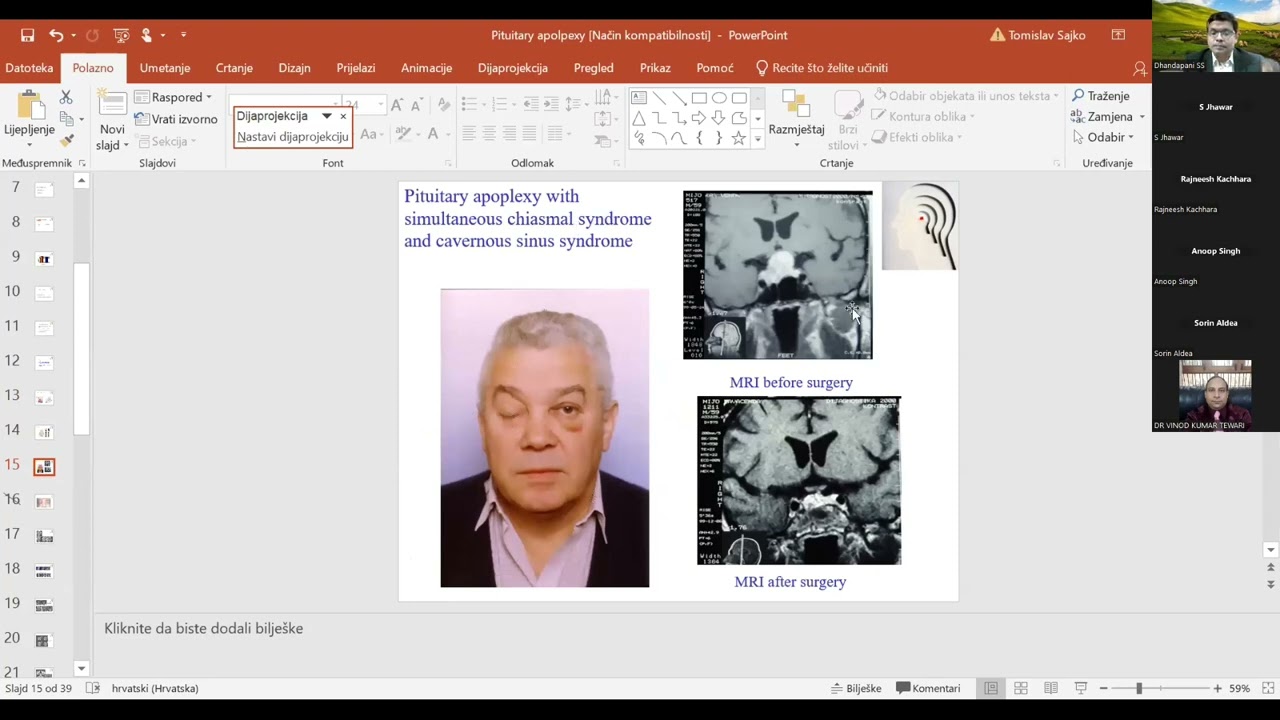 Pitutary Apoplexy –  Professor Tomislav Sajkp