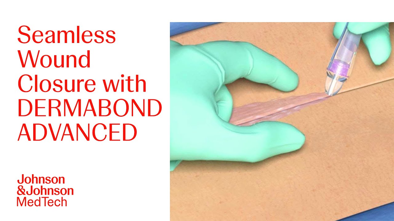 How To Apply DERMABOND ADVANCED Topical Skin Adhesive Effectively | J&J MedTech