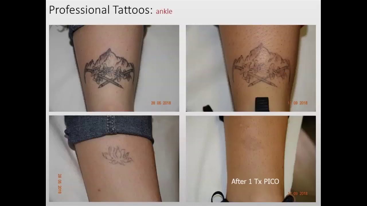 Webinar 'La forma adecuada de tratar tatuajes, lesiones pigmentadas y rejuvenecimiento con PicoWay'