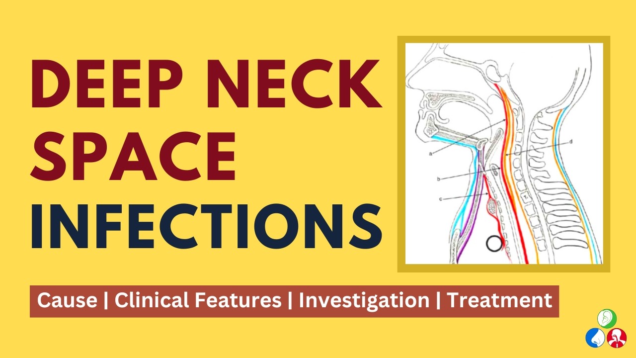 Инфекции глубокого пространства шеи