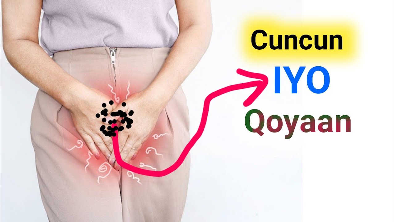 qaladaadka sababo cuncunka iyo qoyaanka xubinta taranka ee dumarka
