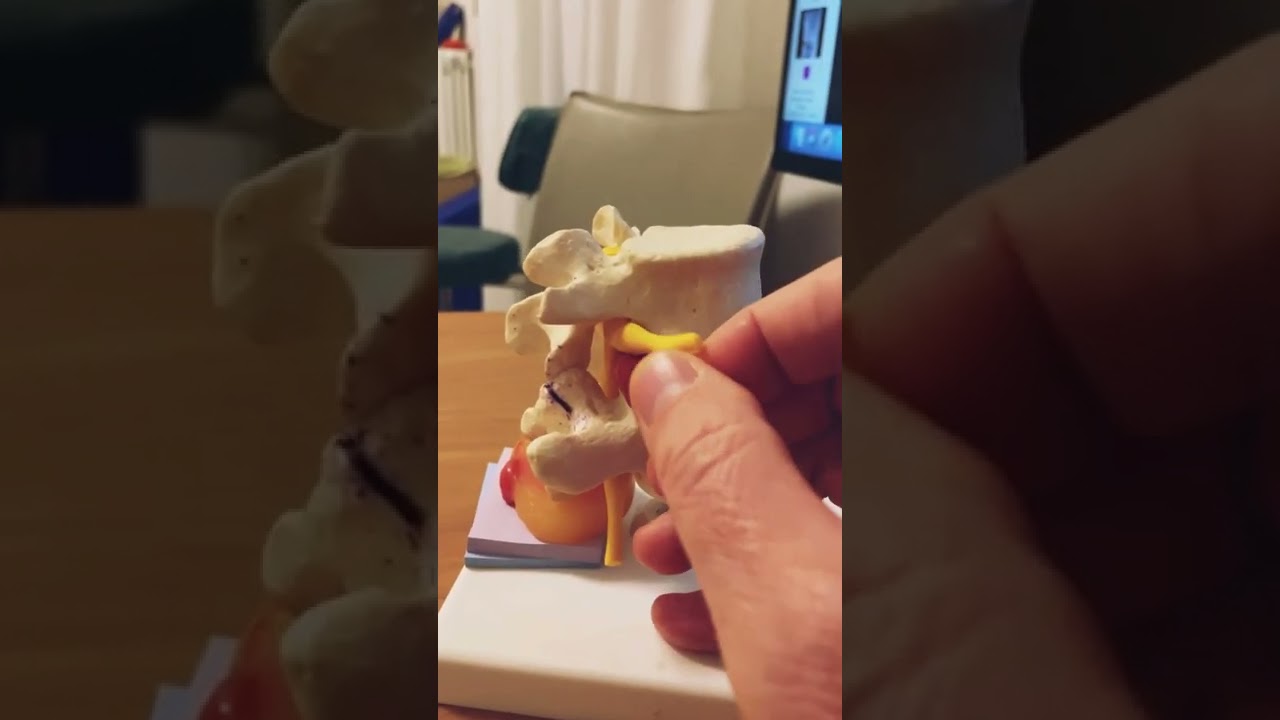 Intervento per ernia discale, indicazione