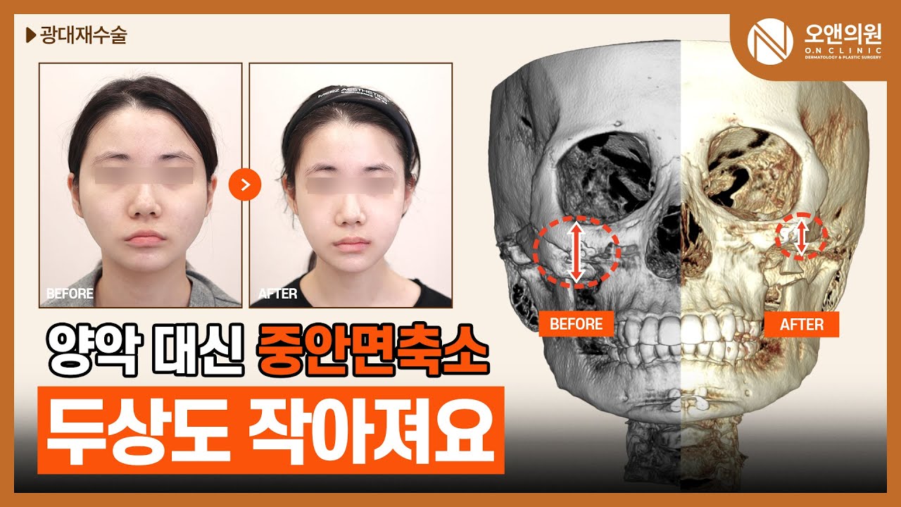 양악 대신 중안면축소, 두상도 작아져요 | (JPN/CN/ENG SUB) #윤곽 #중안면축소수술 #광대비대칭 #성형 #양악수술