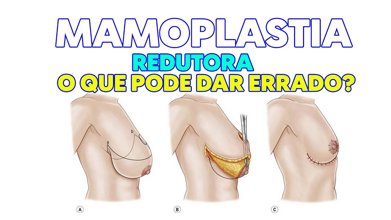 MAMOPLASTIA REDUTORA - 5 ERROS