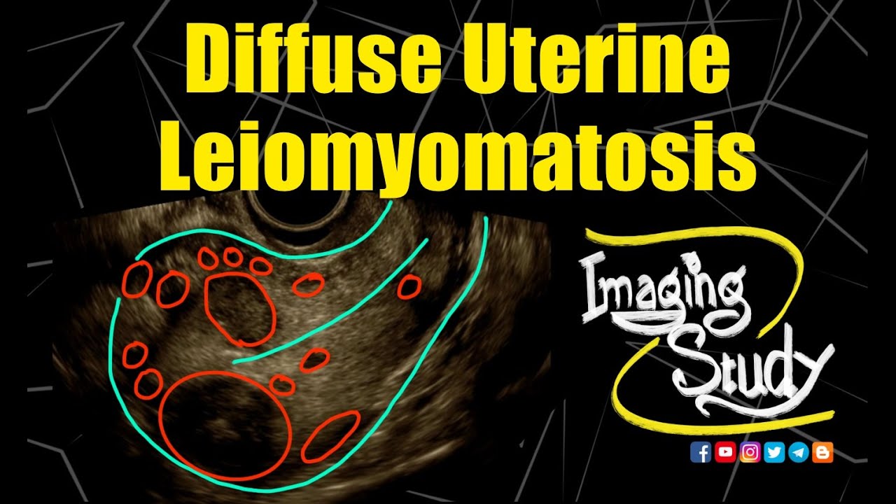 Diffuse Uterine Leiomyomatosis | Fibroids || Ultrasound || Case 286 || Bonus | Dengue Fever