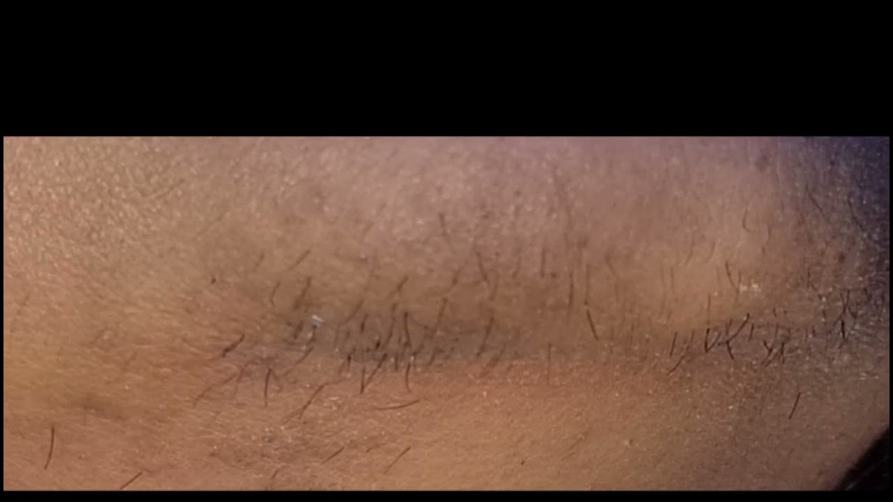 Home electrolysis hair removal permanently=4 Comparison now and after.