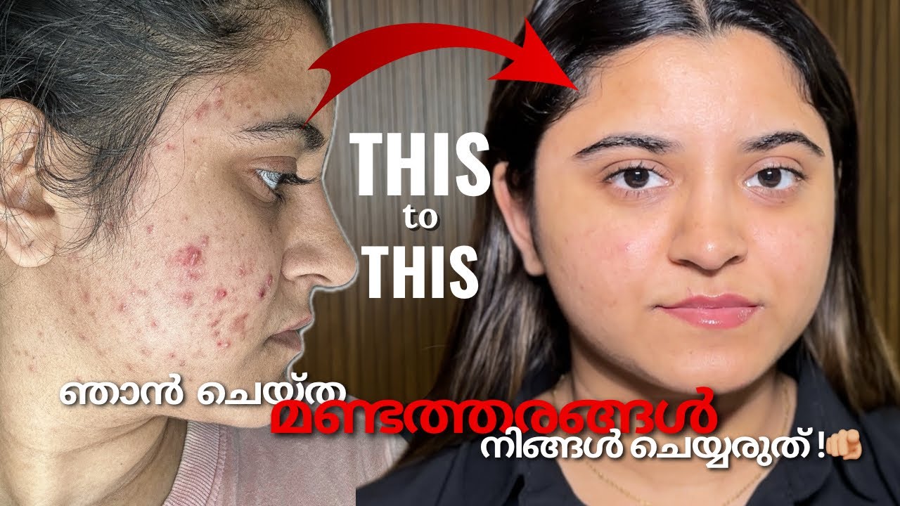 Real Acne Recovery Story💯| ഞാൻ ചെയ്ത treatments ഇതൊക്കെ💊| Henna Enn