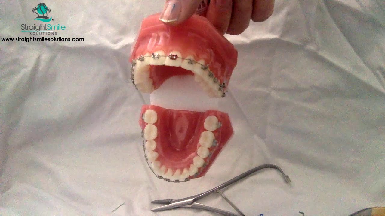 Digital Education: Cynch, Sectional Wires and CCS https://www.straightsmilesolutions.com/