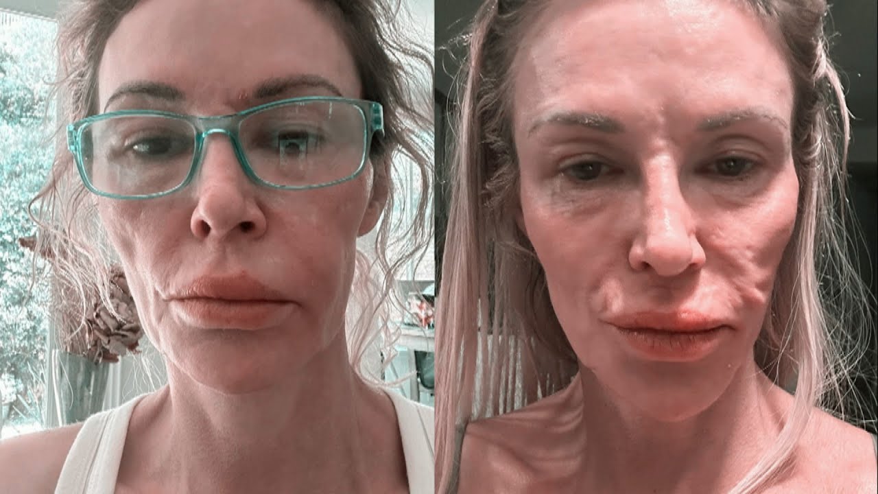 RHOBH&rsquo;s Brandi Glanville Says She&rsquo;s Spent $70K on Face Parasite Treatment (Exclusive)