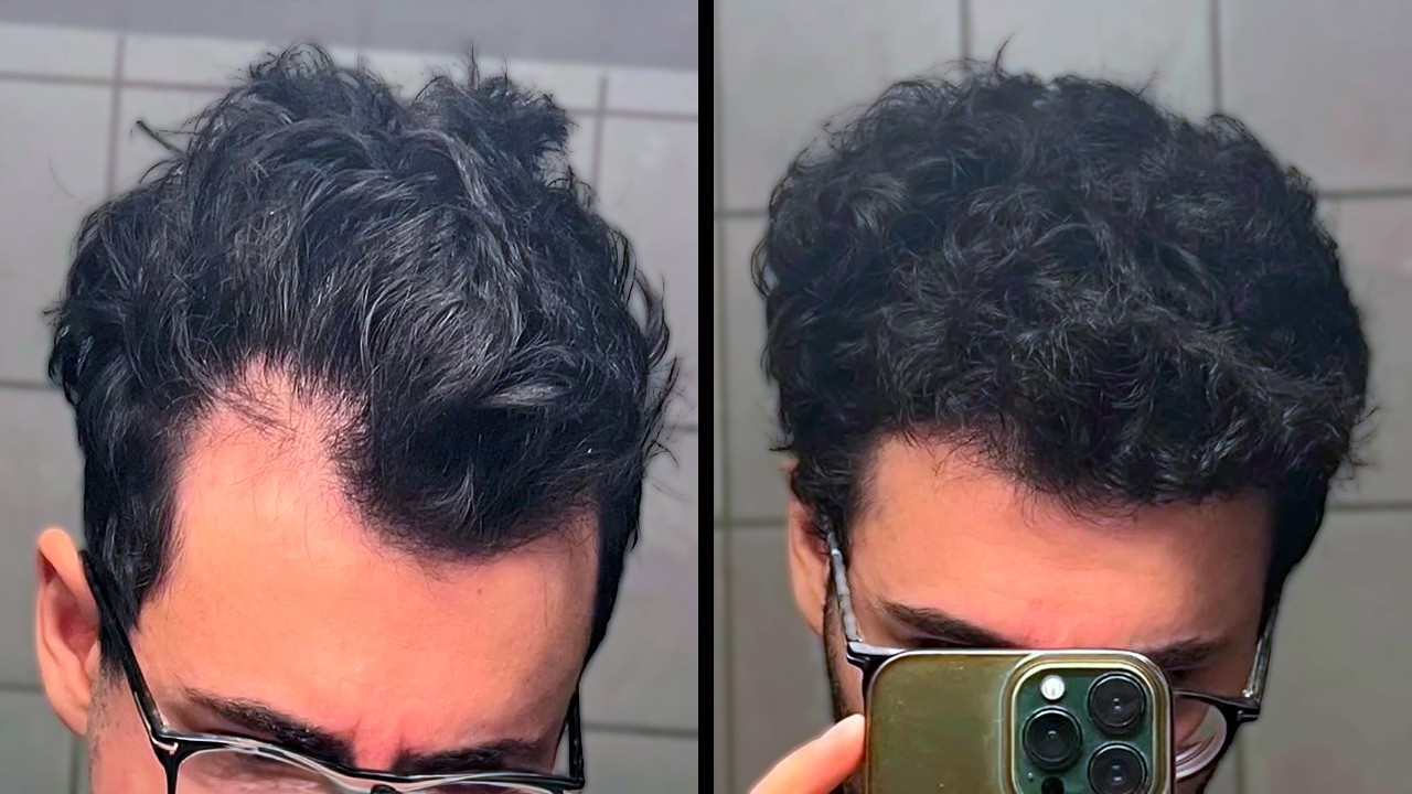 Cómo Recuperé El Pelo De Las Entradas Sin Injerto