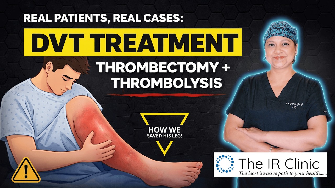 DVT (Blood Clot) Treatment LIVE 🚨 | Thrombectomy + Thrombolysis (Step-by-Step) | Full Case Study