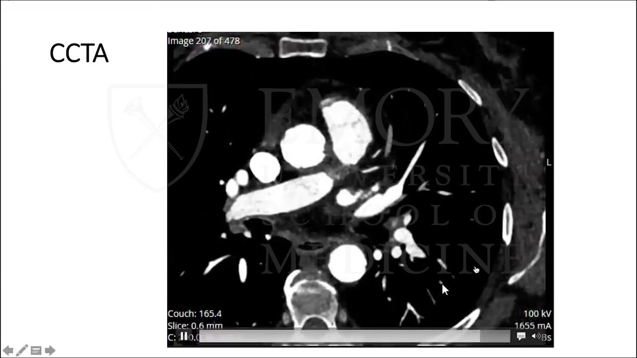 A Unique Case of Coronary Artery Stenosis