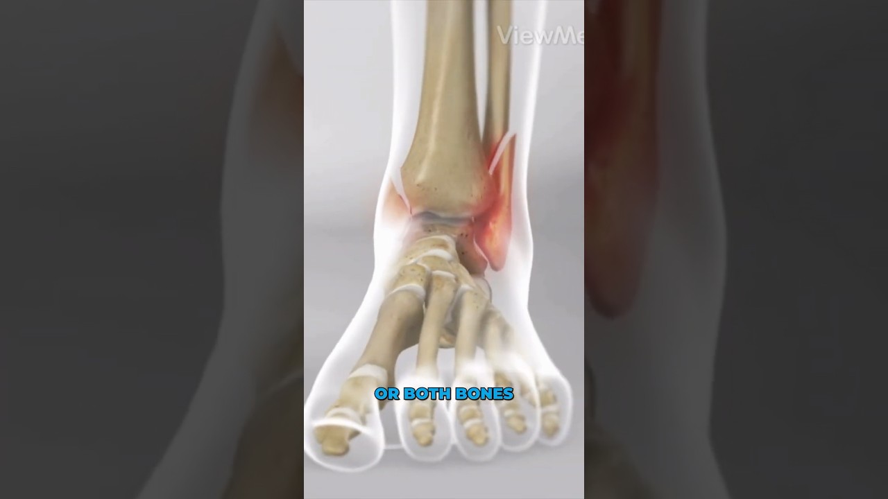 Ankle Fracture Surgery (3D Animation)