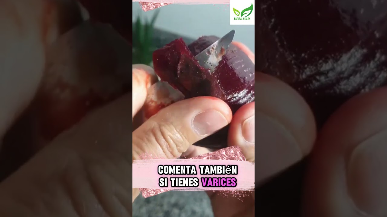 Elimina todas tus varices con solo 2 ingredientes 😱✨ #remediosnaturales #varices #piernasbonitas