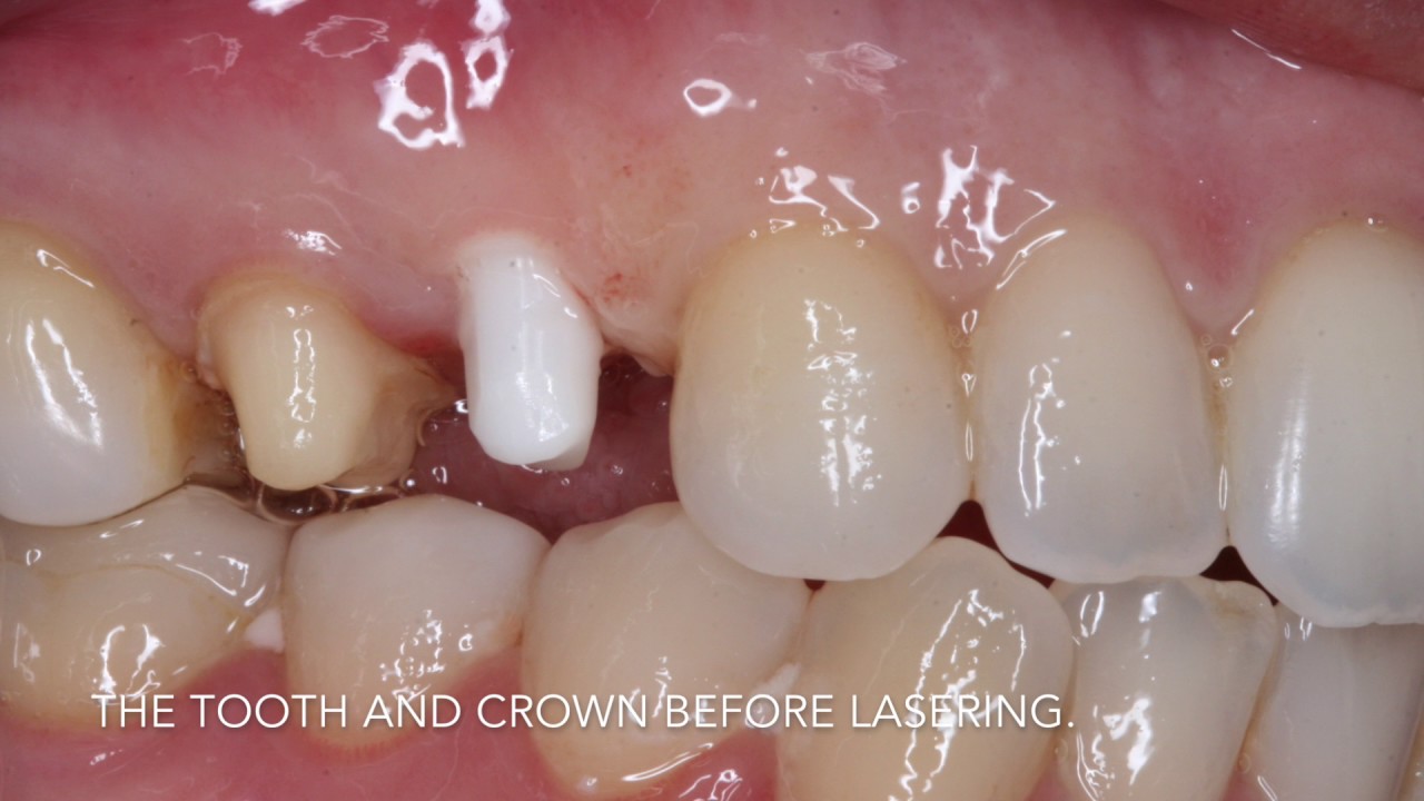 Tapered Z Systems Implant Case