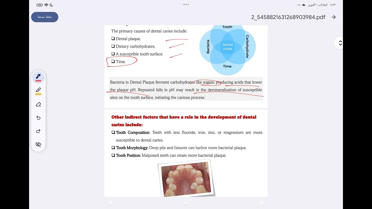 oral pathology lec 2 dental caries مرحلة رابعة طب اسنان