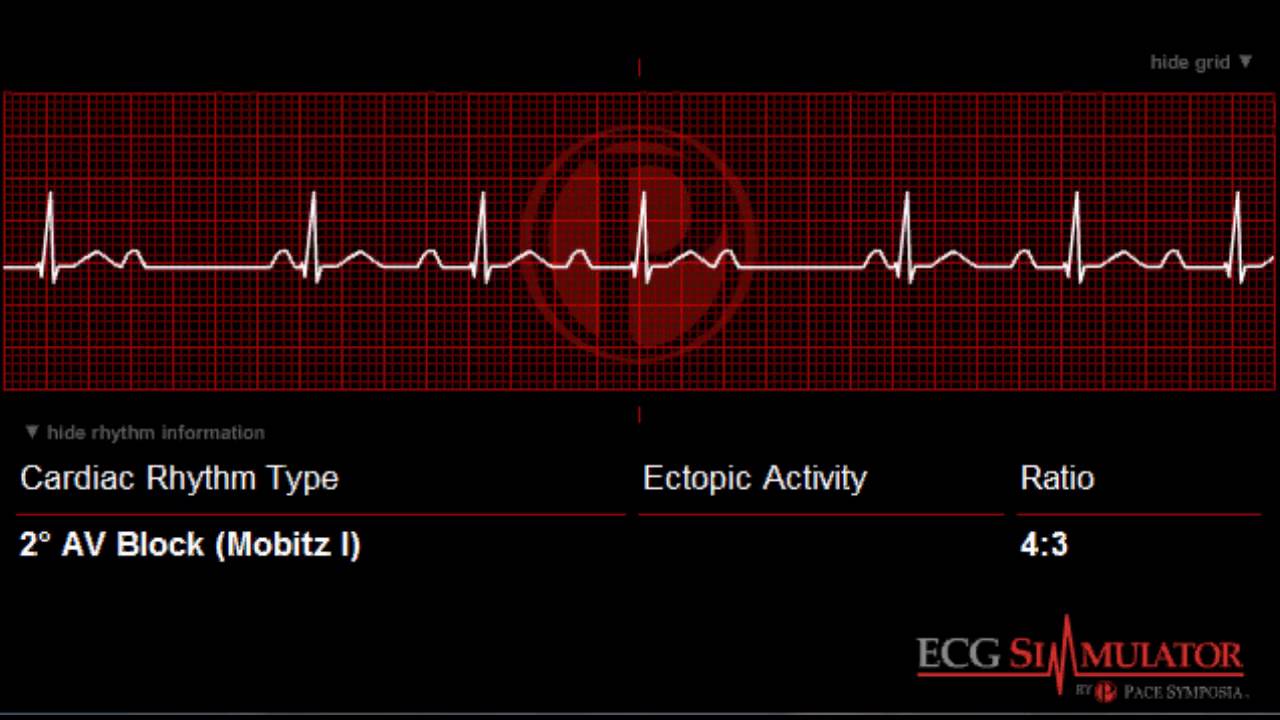 Second Degree AV Block Type I / Wenckebach ECG / EKG (ecgsimulator.net)