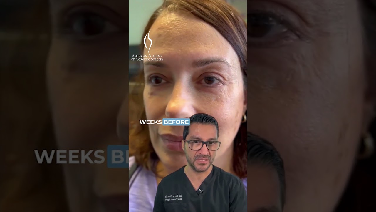Filler Complication Treatment #medicaleducation #fillercomplication #cosmeticsurgery #fellowship