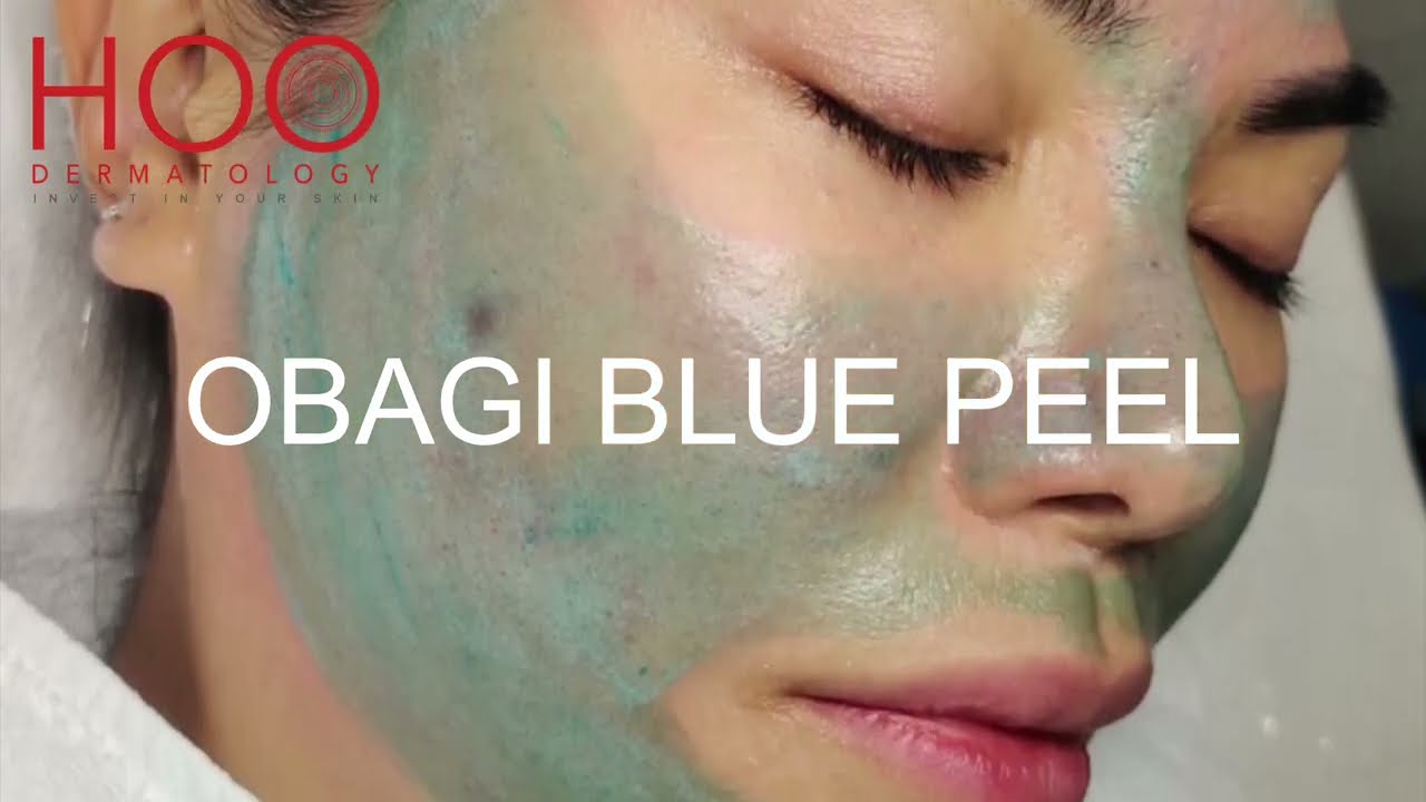 OBAGI BLUE PEEL TREATMENT