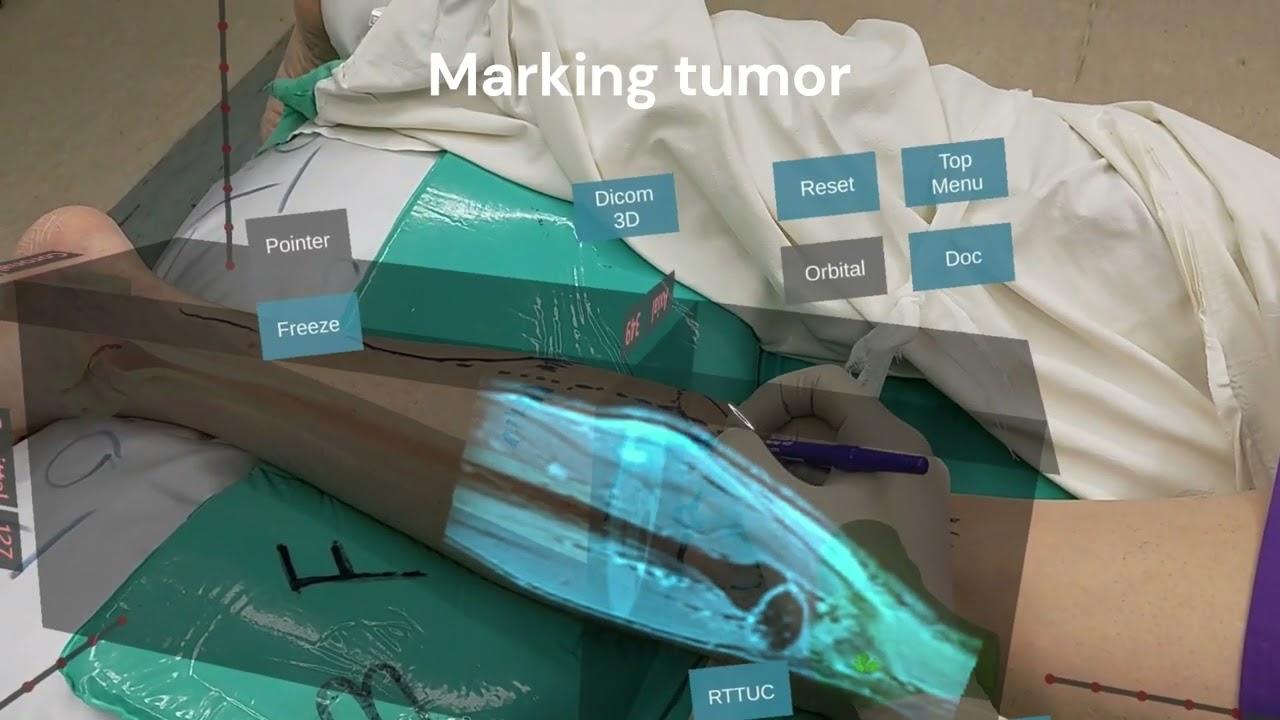 MR technology in orthopedic oncology surgery - Supplementary video 2 [ID 421077]