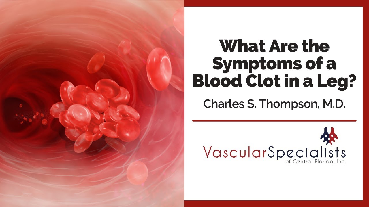 What Are the Symptoms of a Blood Clot in a Leg? | Charles S. Thompson, M.D., F.A.C.S.